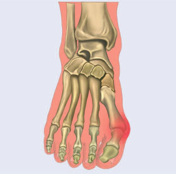 Läuft der Fuß nicht rund, hinkt der ganze Mensch Fuß- und Sprunggelenksschmerzen stören den Bewegungsablauf Fuß- und Sprunggelenksschmerzen, Entzündungen des Großzehengrundgelenkes,