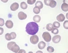 Baurmann et al.: Lymphozytenmorphologie im Blutausstrich 269 peripheren Blut jedoch selten vorkommende lymphatische Zellen wie Plasmazellen, wie auch zun ä chst nicht einzuordnende Zellen.
