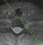 Radiologie: C3/4 links Radiologie: C7 / Th1 C3 C3 C7 C7 Arbeitsdiagnose: Schmerzanalyse Syndrom des cervicothorakalen Überganges: Myofasciale Befunde Scalenuslücke und costo-pectorale Lücke