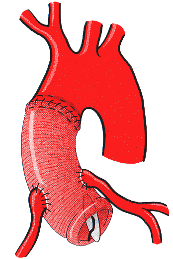 Aortenwurzel, kann ein Aorta ascendens Ersatz mit getrenntem Aortenklappenersatz durchgeführt werden. Bei dieser Operation nach Wheat (Wheat et al.