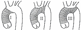 Befestigung der angepassten Prothese an den Rändern der einzelnen Klappentaschen durchgeführt.