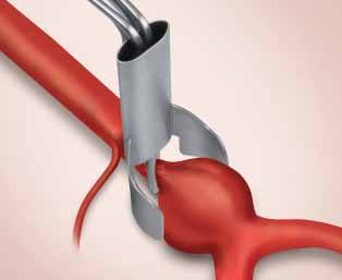 For the treatment of pathological tubular structures in the abdominal cavity such as abdominal aortic aneurysm, a retractor with recession offers wider exposure of the neck of an aneurysm and