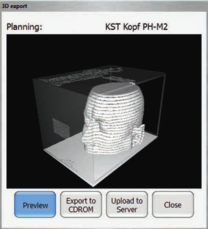3D-Druck von patientenspezifischen Strukturen Das neue 3D-Exportmodul ermöglicht 3D-Modelle das Ausdrucken von patientenspezifischen Strukturen.