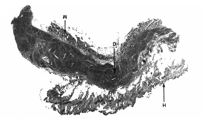 Mammagewebes, H: Haut, D: Drüsengewebe Abb.