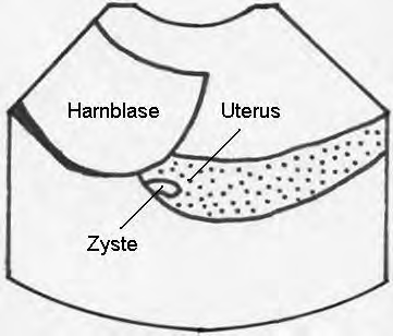 zystischer Endometriumshyperplasie (7,5 MHz Sektorschallkopf,