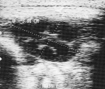 Abb. 4: Optimale Darstellung der linken Niere im Sagittalschnitt mit dem 5