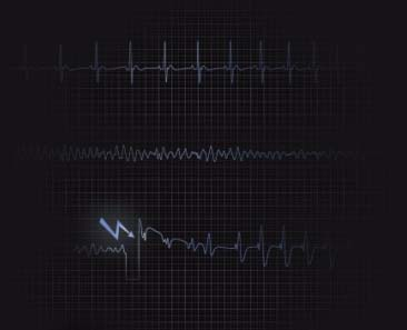 Normal heartbeat (60 80/ Minute) VF =Ventricular Fibrillation (> 300 beats per min) VF Shock normal heartbeat Was passiert? Das Herz schlägt in der Regel 60 bis 80 Mal pro Minute.
