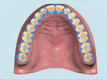 direkt in den Parodontalspalt des zu anästhesierenden Zahnes injiziert wird. Der Einstichschmerz ist minimal und das Herz-Kreislaufsystem wird nicht unnötig belastet.