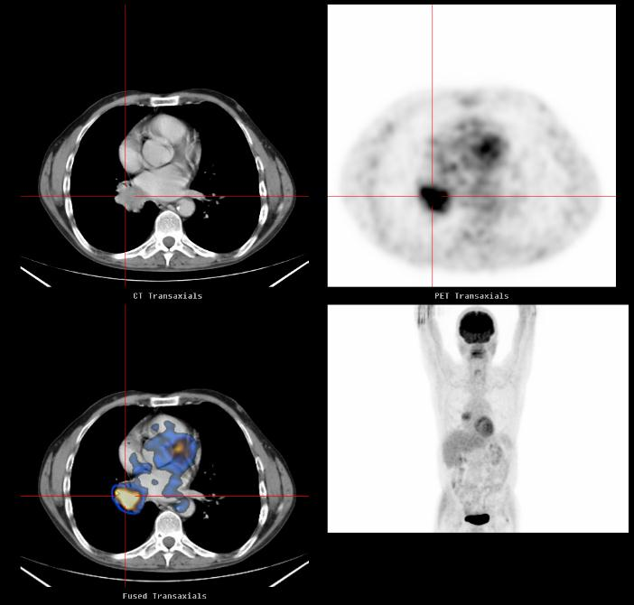Einleitung Abbildung 3: Patient mit kleinzelligem Bronchialkarzinom rechts. Links unten: transaxiale FDG- PET-CT-Aufnahme(Positronen-Emissions-Tomographie mit 2-[ 18 F]Fluoro-2-Desoxy-D-Glucose).