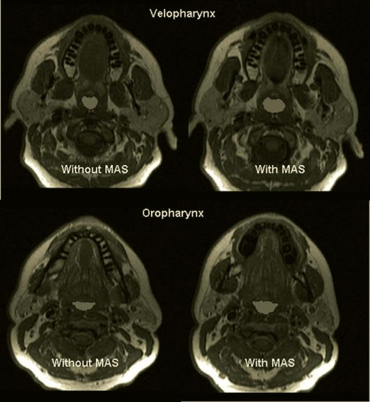 Abbildung 3: Axiale MRT-Schnitte auf Höhe des Velopharynx und des Oropharynx. Auch hier leidet der Patient an OSA.