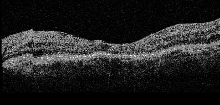 4: Optische Kohärenztomographie vier Wochen postoperativ und nach Avastingabe: physiologische Architektur der Neuroretina nahezu wiederhergestellt, Netzhautdicke: 310 µm (central area retinal