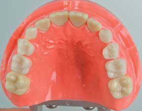 oralen Phase des Schluckaktes die korrekte Platzierung der Zungenspitze unterstützt eine korrekte Lautbildung und wirkt zudem einer