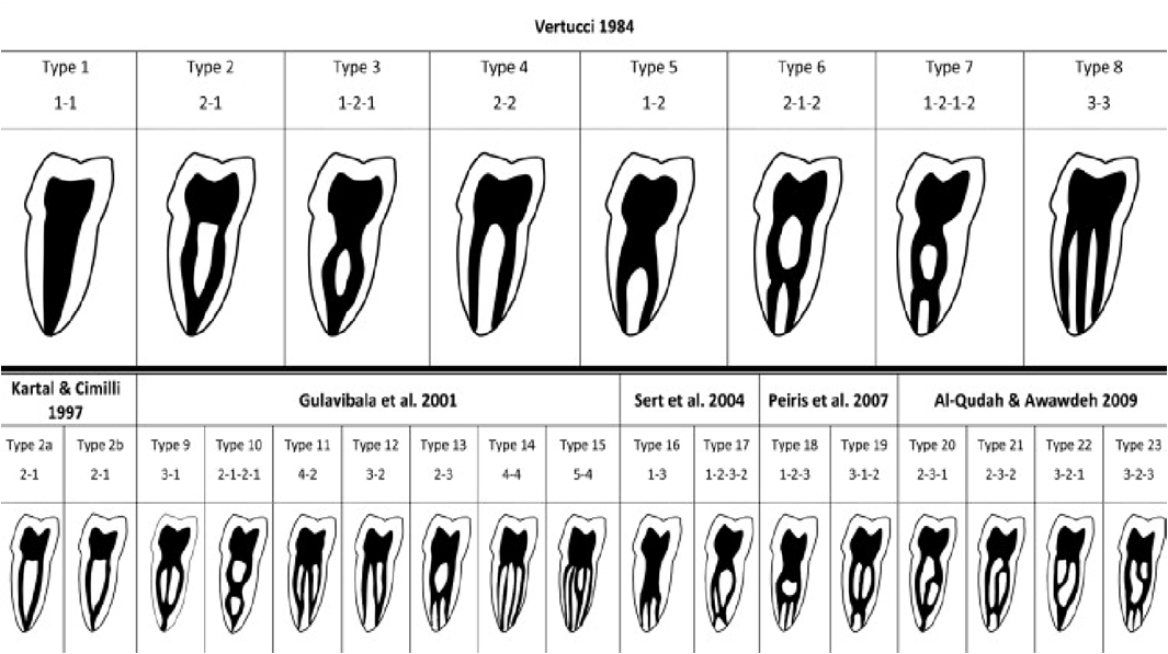 Literaturübersicht Abb. 3: Wurzelkanalkonfiguration. Abbildung entnommen aus: http://www.endopracticeus.com/ce-articles/treatment-of-mandibular-first-molars-with-five-rootcanals/; entnommen am 22.02.
