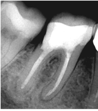 11: Zahn 46 (unvollständige Heilung), a) periapikaler Osteolyse zum Zeitpunkt