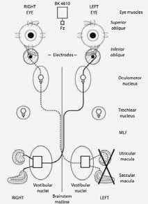 ovemp!! Kontraktion des " M. obliquus inferior auf Beklopfen der Kalotte (Reflexhammer oder Minishaker)!