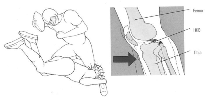 Bandrupturen am Knie) [Peterson 2002] Knieverletzungen - PCL