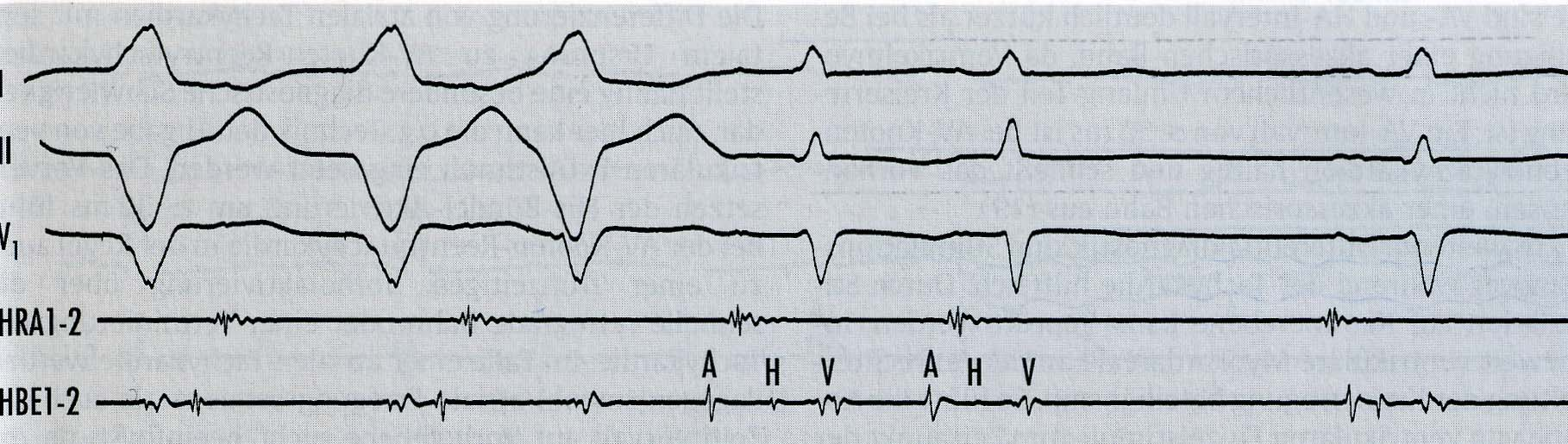 EPU-Technik intrakardiales Ekg V: Ventrikelstimulation mit