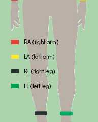 ICR (Zwischenrippenraum) parasternal (neben dem Brustbein) rechts. V2 im 4 ICR.