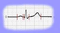 Das EKG Ableitungsarten