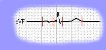Das EKG