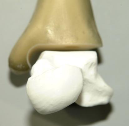 Um die reproduzierbare Implantation eines intramedullären Nagels durch Talus und Calcaneus zu gewährleisten, wurde mittels einer teilbaren Form aus Epoxidharz eine definierte Ausrichtung von Talus zu