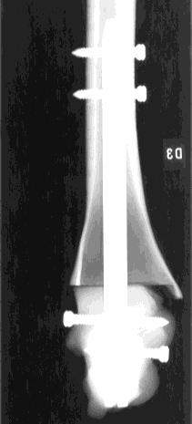 Material und Methode Als distale Verankerungsschrauben im Calcaneus wurden eine 5 x 35 mm Schraube [ML] sowie eine 5 x 75 mm Schraube [AP] verwendet.