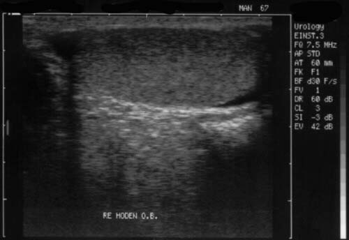Bild 2: Sonographie des Hodens bei einem Normalbefund. Bild 3: Sonographie bei Mischtumor aus Dottersacktumor und Embryonalzellkarzinom.