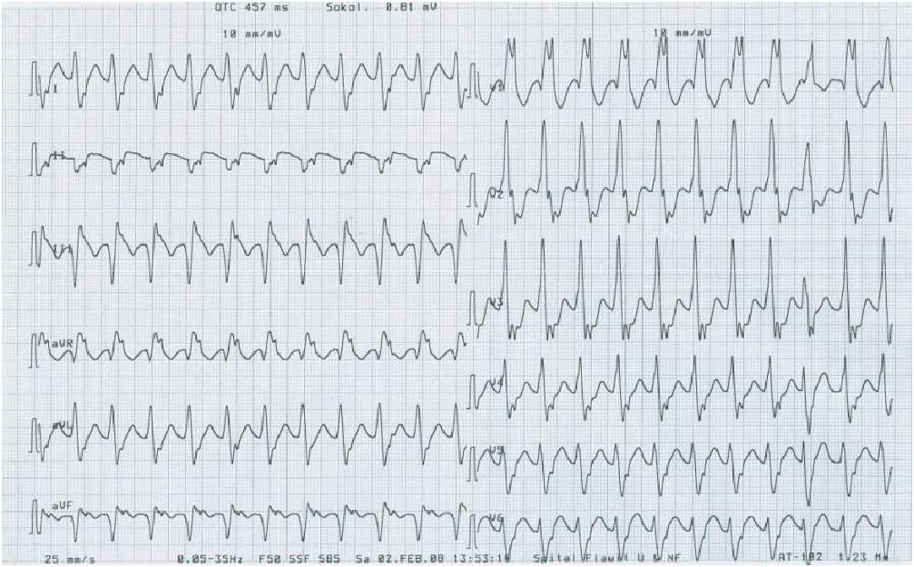 Anfalls-EKG: