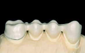 Zuerst muss der Modellstumpf nochmals mit IPS Ceramic Separating Liquid isoliert werden. Anschliessend die fehlenden Bereiche ergänzen und die Schultermasse in den durch den 1.