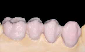 1. Dentin- und Incisalbrand Vor Beginn der Dentin- und Incisalschichtung wird das Modell isoliert. Dadurch wird ein Festkleben bzw. Austrocknen der Keramikmassen am Modell verhindert.