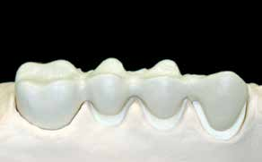 Opaquer-Brand Pastenopaquer 1. Opaquer-Brand (Wash) (Pastenopaquer) Der pastenförmige IPS InLine System Opaquer wird entsprechend der Zahnfarbe ausgesucht.