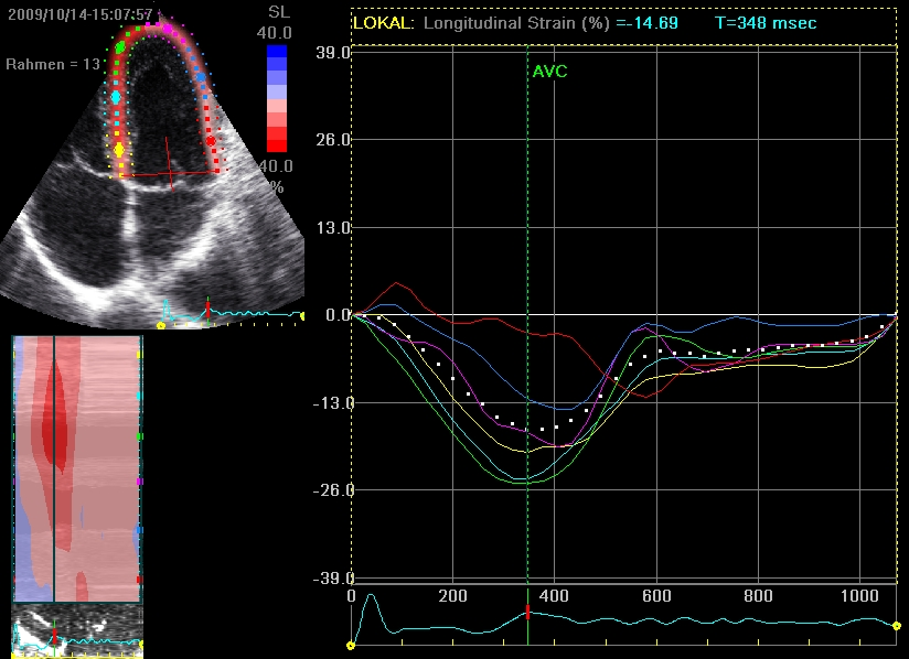 mit einer hohen zeitlichen Auflösung bestimmt werden. Eine andere Methode zur Bestimmung von Strain und Strainrate ist die 2D Echokardiographie basierend auf der Speckle-Tracking Technik.