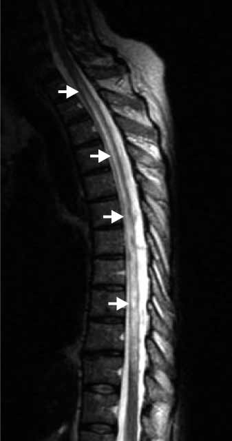 J. Dörr: Neuromyelitis optika und Susac-Syndrom 481 lich in etwa 10% auf (13).