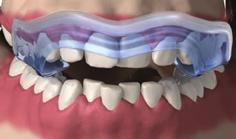 Pressen oder Knirschen mit den Zähnen (Bruxismus) Schluckbeschwerden die schnelle Schiene bei CMD