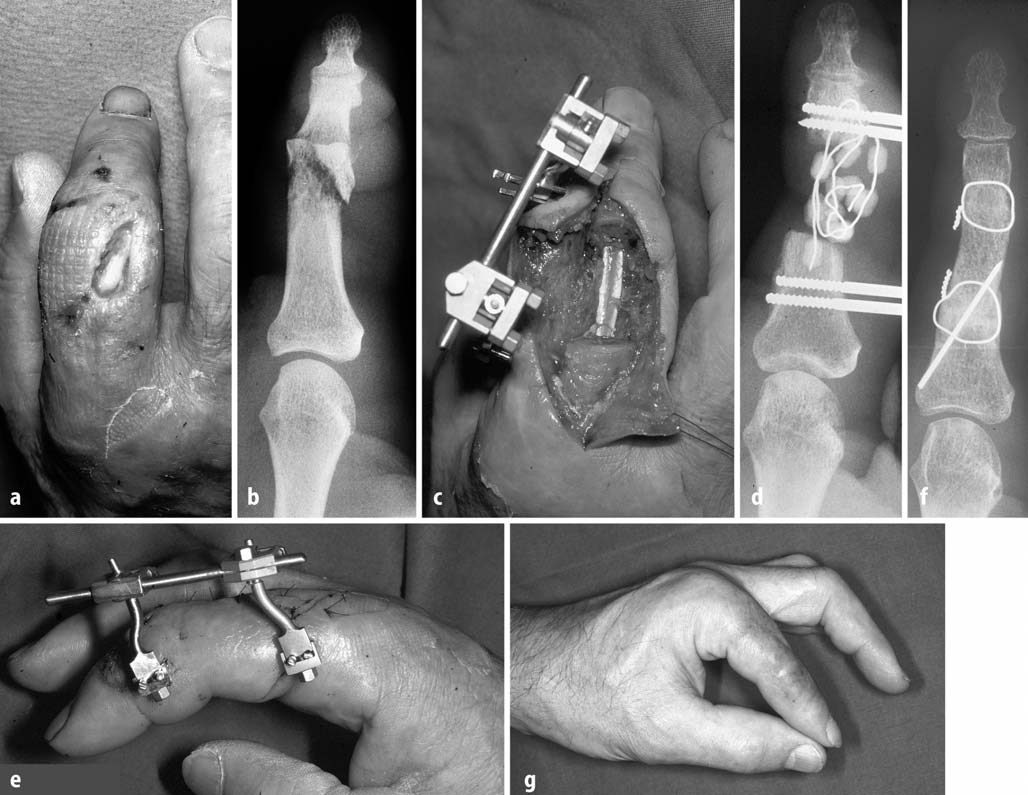 Abb. 2 a g Distale Grundgliedfraktur, a, b Osteitis des Zeigefingergrundglieds nach distaler Grundgliedfraktur und Osteosynthese mit Kirschner-Drähten, Weichteildefekt, Nekrose des