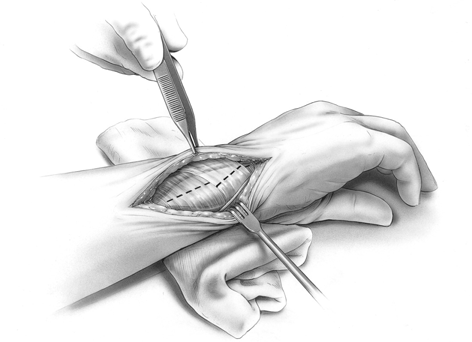 uhead Ulna-Implantatsystem Operationstechnik OPERATIONSVERFAHREN 1 Inzision, ulnarer Zugang Die ulnare Inzision erfolgt entlang des ulnaren oder medialen Schafts der distalen Ulna in einer Linie mit