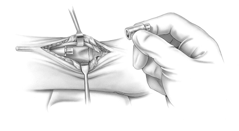 8 Einsetzen des Probekopfes und Probereposition Der Probe-Ulnakopf wird auf den Hals des implantierten Probeschaftes (bzw.