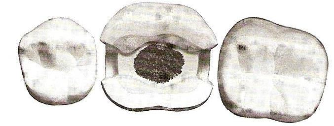 Proximale Präparation ist ähnlich, wie im Fall von Inlay-Präparation war. Die approximale kariöse Lesion gibt die Ausdehnung des approximalen Kasten vor.