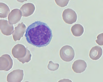 Normwe Myelozyt 4.5% Metamyelozyt 5.