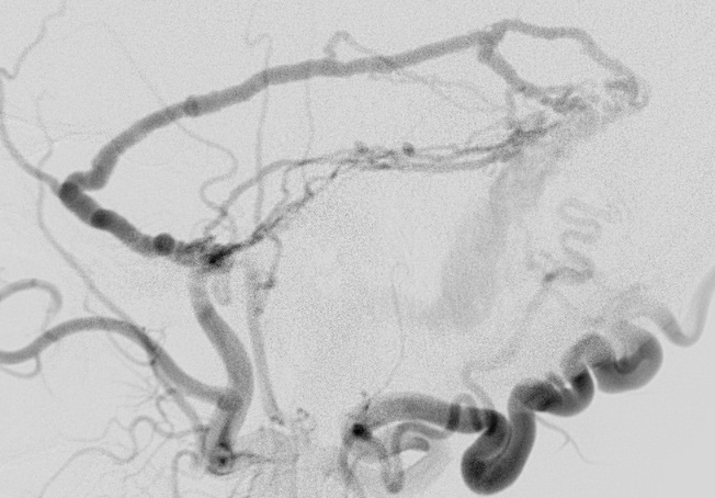 Einleitung 5 Abb. 2: Fistelgrad IIa: Arterielle Feeder aus der der A. meningea rechts.