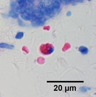 5 Neutrophile Granulozyten Zur Unterscheidung von eosinophilen und neutrophilen Granulozyten wurden die Bioptate mittels der panoptischen Färbung nach Pappenheim (kombinierte May-Grünwald-Giemsa-