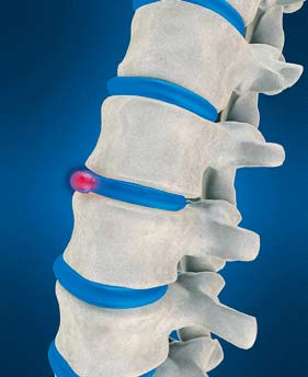 Konzepte 17 Bundesweites Versorgungskonzept Frag den Therapeuten Ein neues bundesweites Versorgungskonzept soll überflüssige Operationen bei Rückenschmerzen vermeiden.
