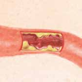 Dies kann folgende Konsequenzen haben: Die Wände der Arterie werden dicker und rauer. Die Plaqueablagerungen behindern den Blutfluss durch die Arterie.
