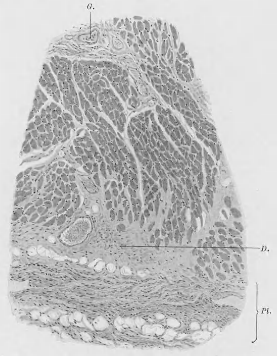 bei Emphysem der Lunge III ginnenden Nekrose Spaltbildung (Abb. 79). In dieser gequollenenmuskelfaser sieht man eingewanderte Leukozyten, die den Abtransport besorgen.