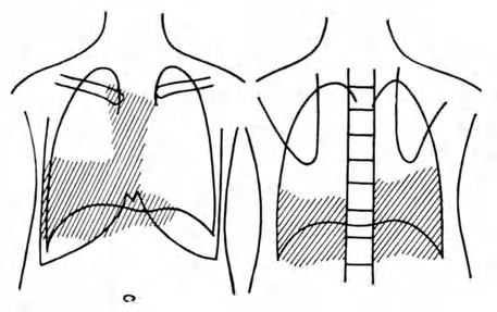 Das von Alteren so geliebte Symptom des Druckes mit der flachen Hand auf den Oberbauch und aus der Differenz der zum Eindrucken notwendigen Kraft auf die Muskelstarke des Diaphragma zu schlieben,