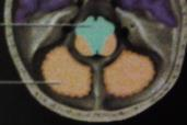 Neuroradiologische Anatomie