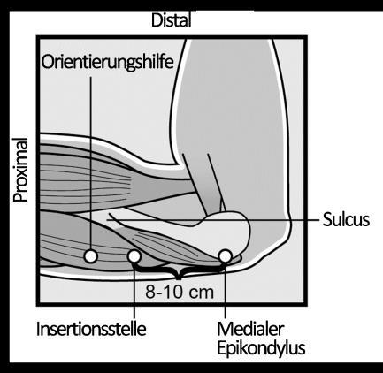 weniger beanspruchten Arm am Ellenbogen nach außen abzuwinkeln, sodass ihr Handgelenk parallel zum Ohr oder ihre Hand nahe am Kopf liegt (Abbildung 1).