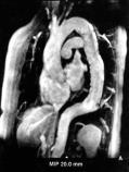 serielle Pn Untersuchungen mit RR-Monitoring und Bildgebungen der Aorta (z.b. MRA) da sonst Gefahr für weitere aortale Komplikationen!