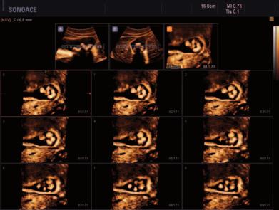 Es ist besonders geeignet für die Untersuchung feiner Strukturen z. B. der Schilddrüse, Gefäße oder in der abdominellen Diagnostik.