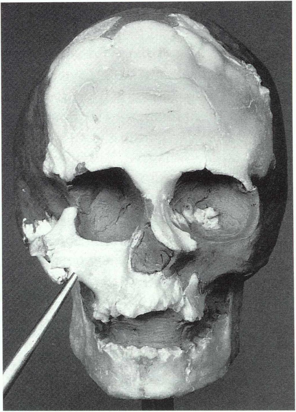 Abb. 2 Modell des Schädels aus dem Grab II In Vergina mit Stiftchen zur Markierung der Ergänzung von Mus kulatur und Haut keine perfekte Rekonstruktion eines Gesichts mög lich; die Erfahrungen aus